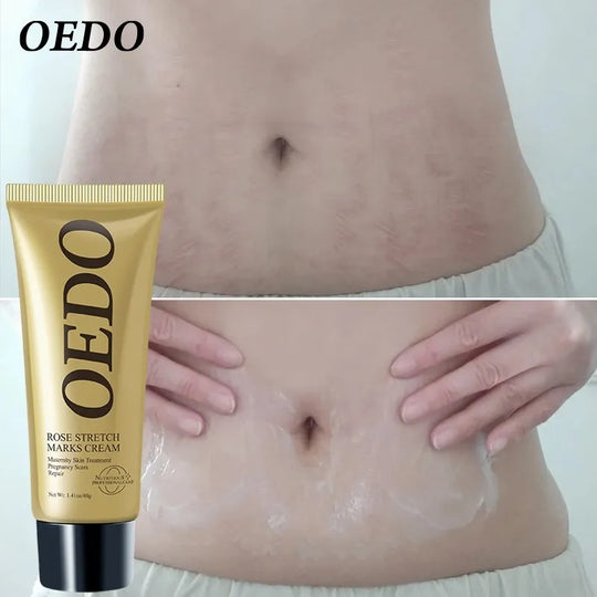 Creme Reparador para Estrias de Gravidez